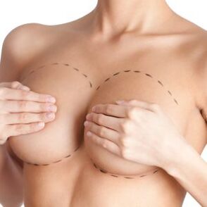 Implantátumok típusai