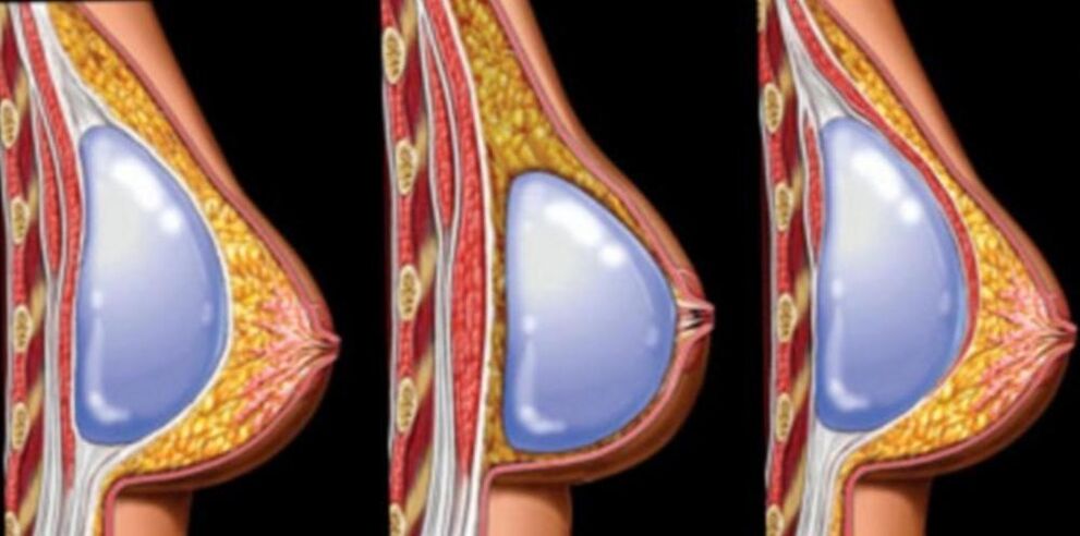 Implantátumok telepítése