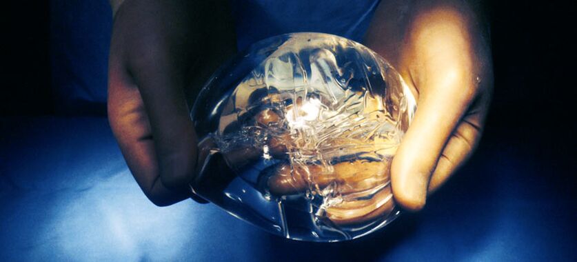 Szilikon endoprotézis